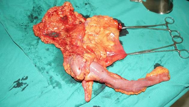 结肠癌同时性肝转移治愈案例,同时性肝转移和异时性肝转移