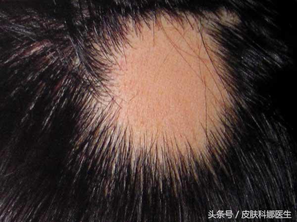 鬼剃头或者斑秃会反复发作吗,鬼剃头斑秃怎么办