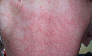 “*品毒**”引起的皮肤病变，触目惊心！