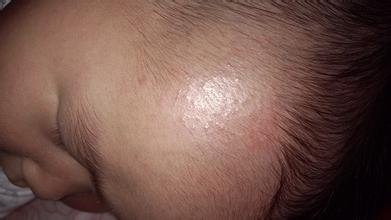 9个月宝宝出疹子注意些什么,宝宝感冒出疹子需要注意什么