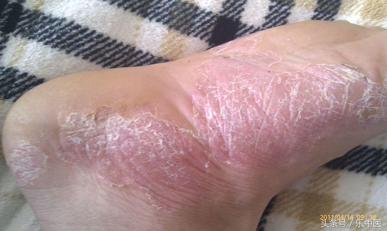 得了脚气很臭怎么办,得了脚气的四个阶段