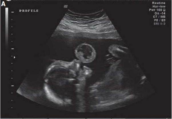 孕晚期胎儿胎死腹中的情况多么,孕晚期胎儿发生胎死腹中概率高吗