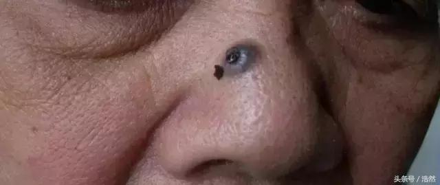 脸上黑斑的图片,消除脸上的黑斑