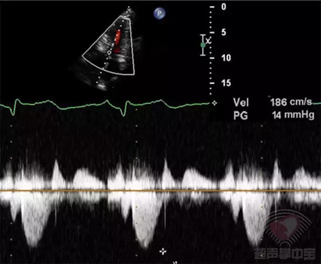 超声肥厚心肌病视频教学,梗阻性肥厚型心肌病消融术