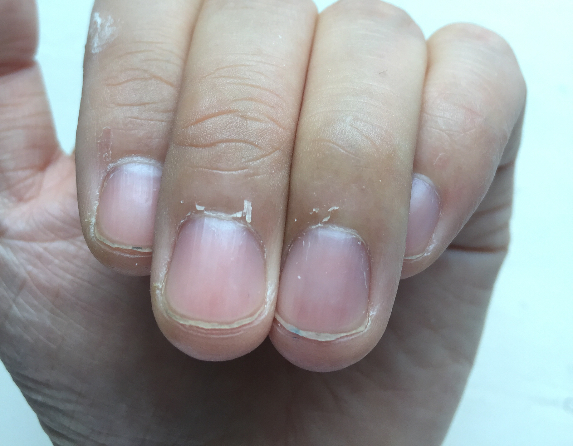 指甲里面莫名其妙长出了一根黑刺,指甲上莫名其妙有一道白色印子