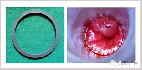 有趣痔疮的知识讲解,怪异的痔疮