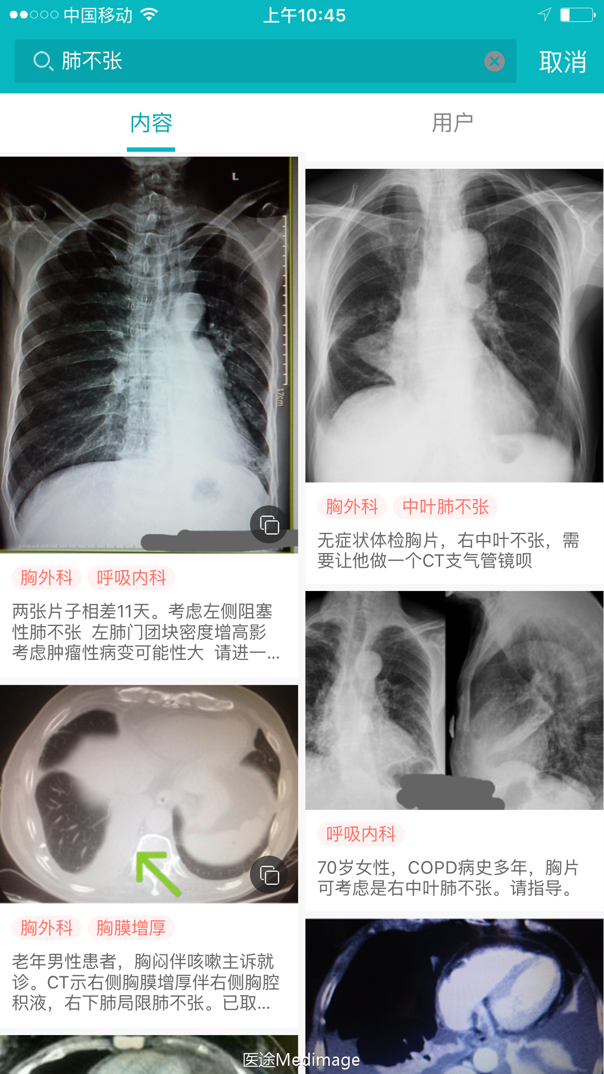 胸部ct扫描双肺未见明显异常,胸部ct报告心脏不大正常吗