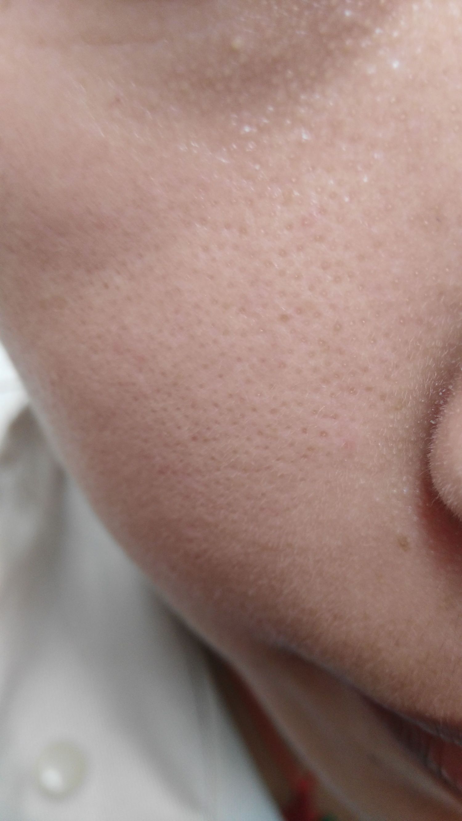 毛孔堵塞怎么办腿部,毛孔堵塞怎么办吃什么药