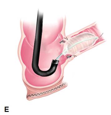 克罗恩病内镜严重程度指数,克罗恩病内镜检查是怎么样的