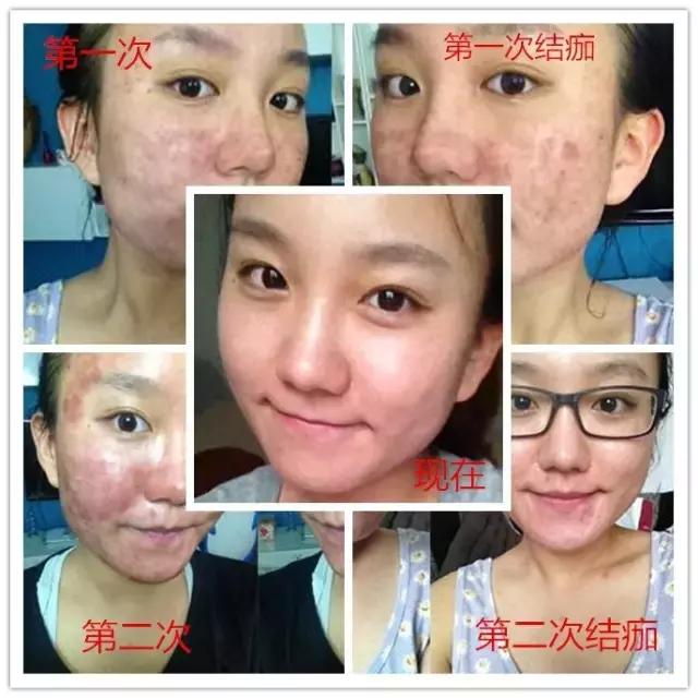 果酸换肤和激光祛痘哪个效果好,激光祛痘和果酸换肤哪个好