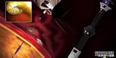 假性囊肿用什么药膏,新生儿假性囊肿