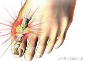 3味中药茶饮,轻松解决尿酸高问题,可预防痛风发作!