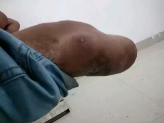 残疾朋友须要注意了：硅胶套，我须要配戴吗？