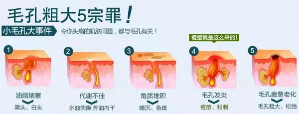 毛孔越挤越大,为啥毛孔越来越粗大越来越多