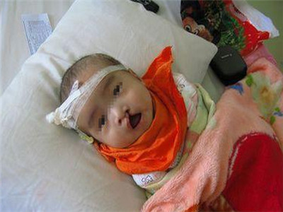 宝宝唇腭裂怎么办,宝宝3级唇腭裂