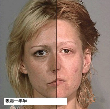 慎点！吸食*毒冰**后脸变形（组图）