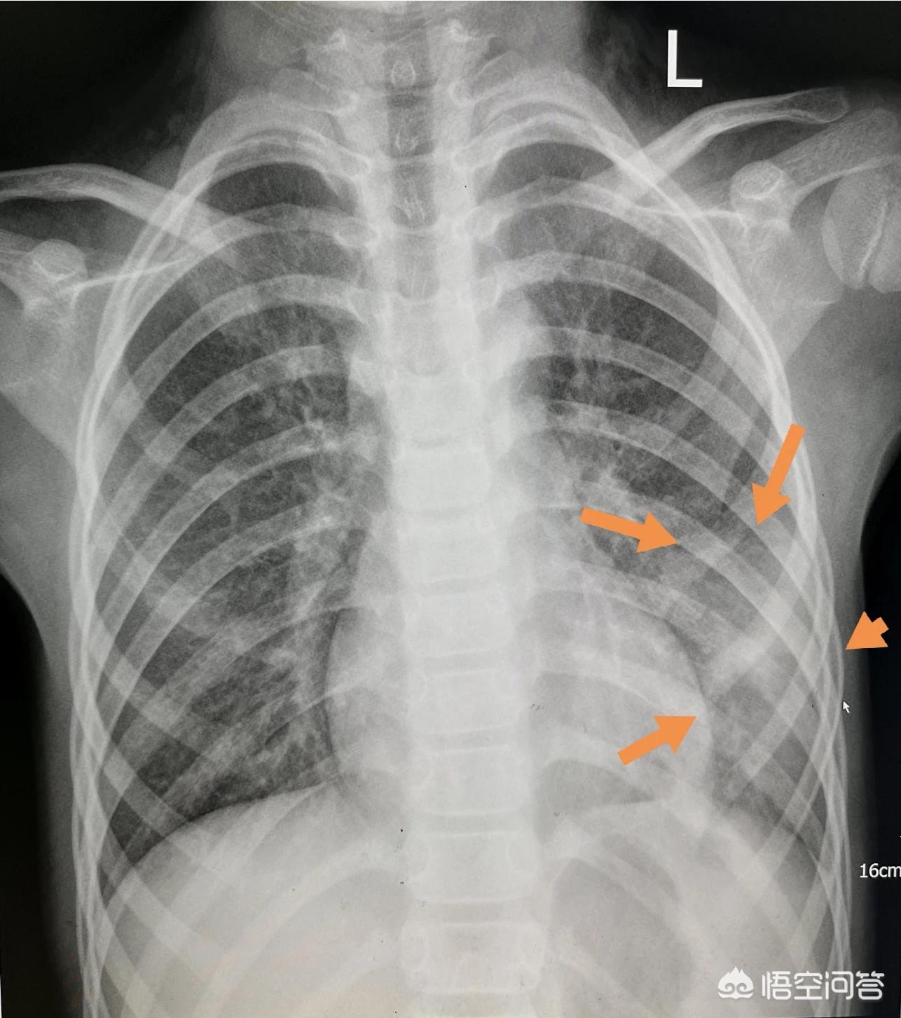 小孩得了肺炎需要打疫苗吗,小孩得了肺炎要打疫苗吗