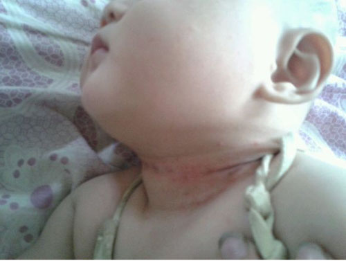 宝宝颈部红烂怎么办,宝宝脖子底下烂了怎么治疗