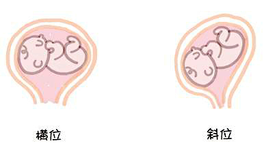 牛胎位不正怎样纠正,胎位不正臀位纠正操
