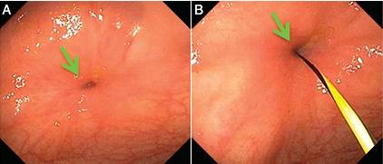 克罗恩病内镜严重程度指数,克罗恩病内镜检查是怎么样的
