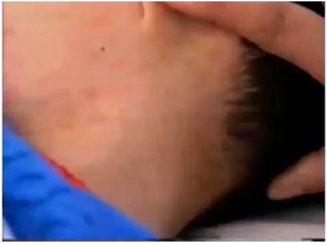 诊断麻疹最快速的方法,麻疹怎么做检测