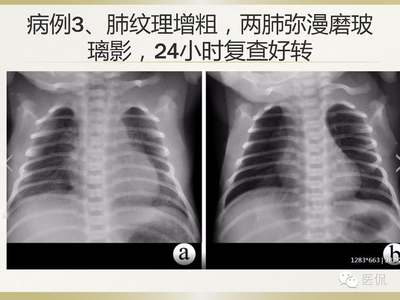 「资料丨医看分享」南边老师肺部群：新生儿透明膜病（HMD）医学影像