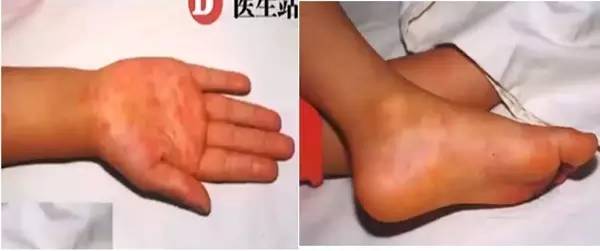 诊断麻疹最快速的方法,麻疹怎么做检测