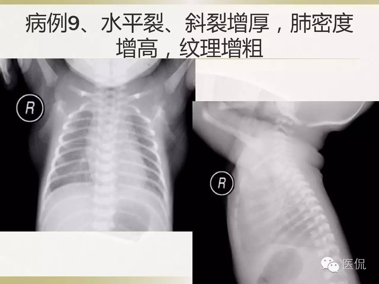 「资料丨医看分享」南边老师肺部群：新生儿透明膜病（HMD）医学影像
