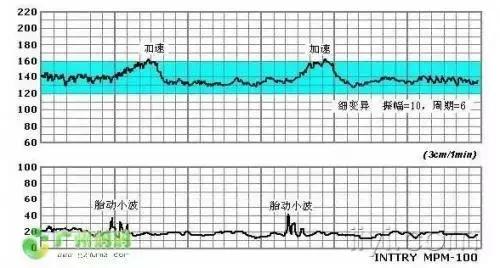 怀孕38周,肚里的娃突然没了胎心?!医生的话太吓人···