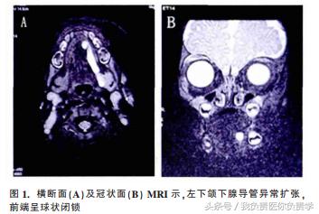 颊部肿物怎么治疗,口底肿物一定是癌变吗