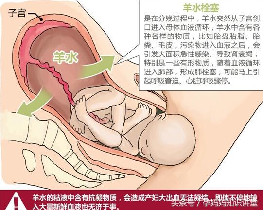 羊水栓塞的预防措施和处理方法,羊水栓塞怎么预防最有效
