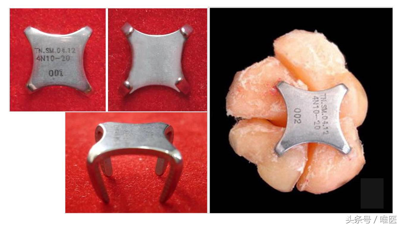 月骨舟骨半脱位手术,手腕舟骨月骨周围脱位要多久康复