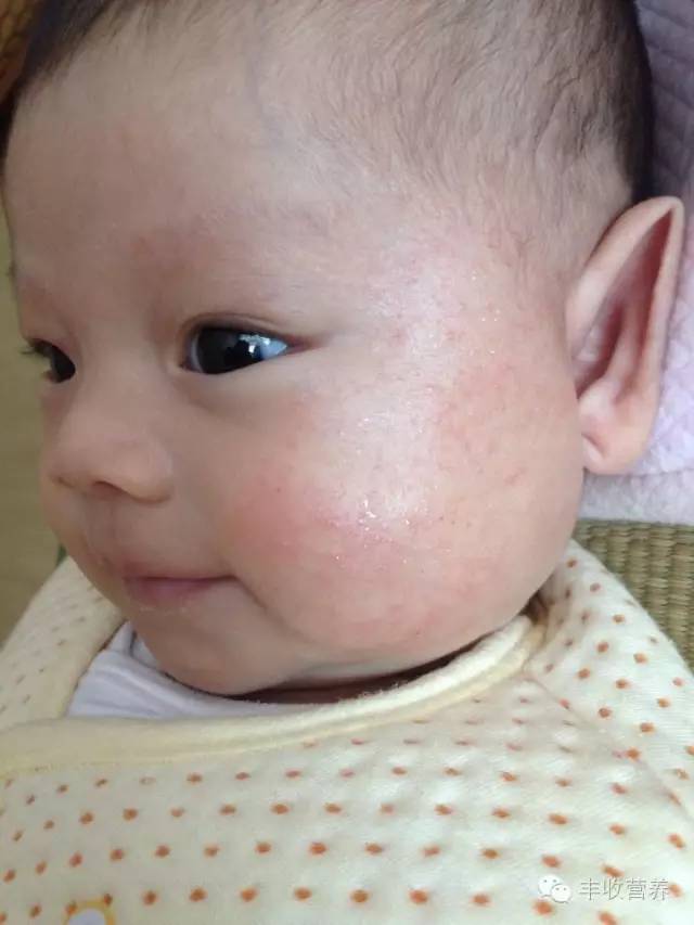治疗宝宝湿疹家长请收好调理食谱,宝宝湿疹怎么给宝妈解释