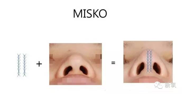 林允是不是整鼻子了,林允隆鼻过吗