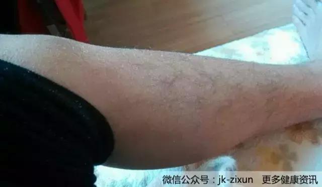 冬天腿上皮肤干燥起皮屑吃哪个药,冬天裤子上很多白色皮屑怎么去除