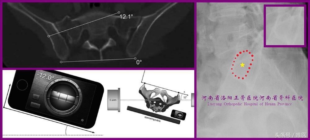 骶髂关节螺钉植入,骶髂关节螺钉手术技巧