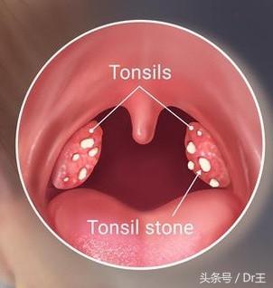 口腔异味感觉黏糊糊的,口腔咳出恶臭颗粒