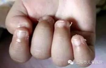 孩子高烧不退当心川崎病,孩子高烧不退当心得了川崎病