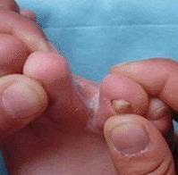 香港脚用什么快速治好,香港脚的最佳治疗方法泡脚