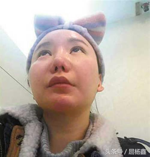 3d手术鼻子整形,鼻子整形手术亲身经历