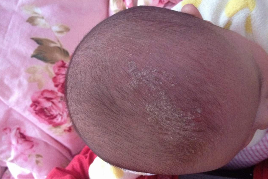 宝宝头垢清理完抹什么药,宝宝洗头垢的方法