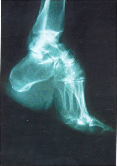 女子缠足,中国妇女缠足从哪年开始