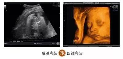 镇原协和医院四维彩超怎么样,镇原做四维多少钱