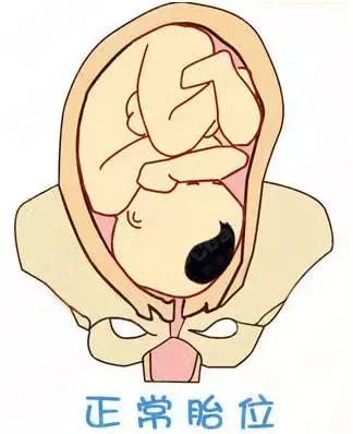宝宝出生的姿势,孩子出生时的姿势