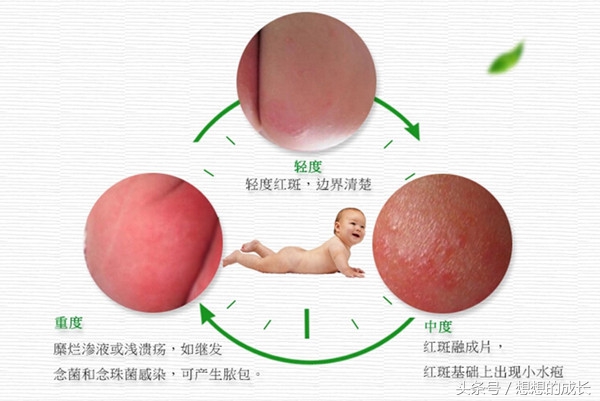 宝宝肺炎住院期间屁股发红,宝宝肺炎而且屁股上身上出红疹子