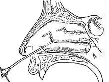 霉菌性上颌窦炎可以吃阿奇霉素,哪些生活习惯会引起霉菌性阴道炎