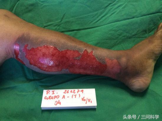 烫伤了不痛,鱼皮治疗烫伤疤痕可以吗