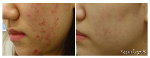 疤痕疙瘩患者不能吃橘子？