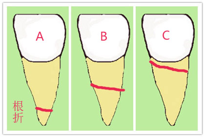 牙齿骨折错位保守治疗能自愈吗,牙齿骨折治疗方法