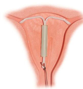 曾为一代人噩梦的节育环，如今还在伤害着他们